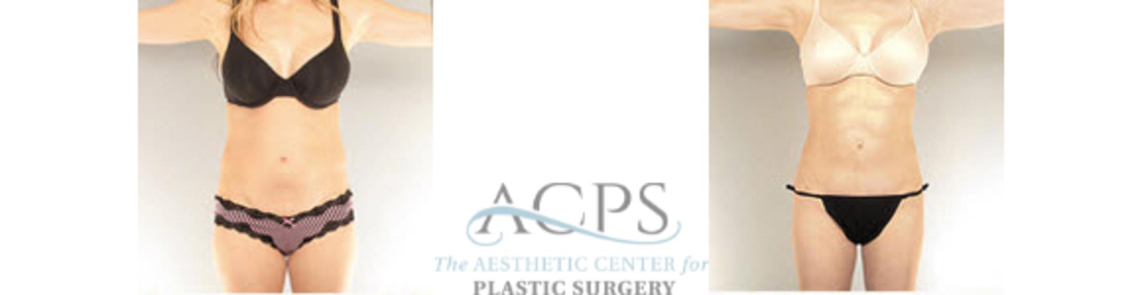 Before & After Liposuction Case 395 Front View: View in Houston, TX