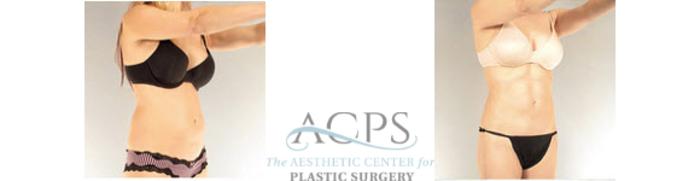 Before & After Liposuction Case 395 Oblique View: View in Houston, TX