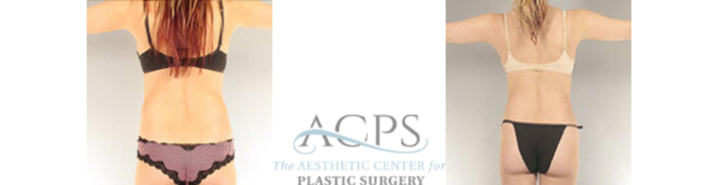 Before & After Liposuction Case 395 Rear View: View in Houston, TX