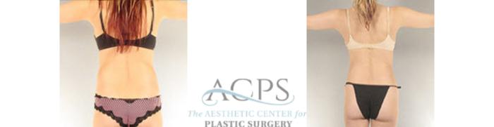 Before & After Liposuction Case 395 Rear View: View in Houston, TX