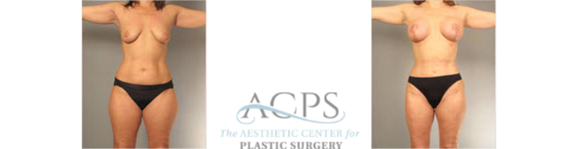 Before & After Liposuction Case 396 Front View: View in Houston, TX