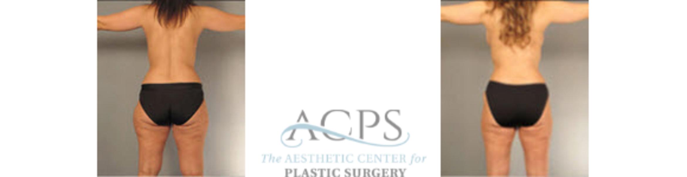 Before & After Liposuction Case 396 Rear View: View in Houston, TX