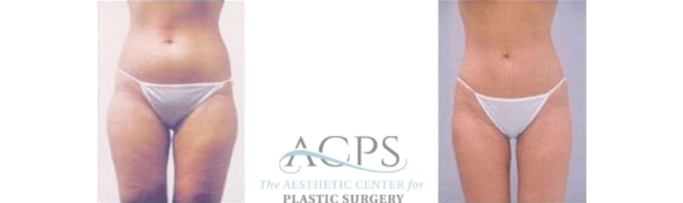 Before & After Liposuction Case 397 Front View: View in Houston, TX
