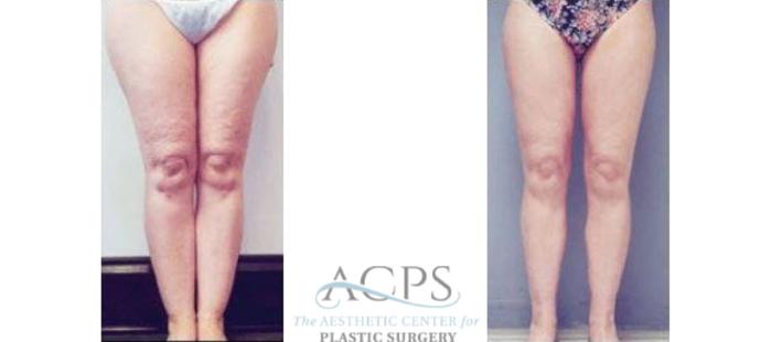 Before & After Liposuction Case 398 Front View: View in Houston, TX