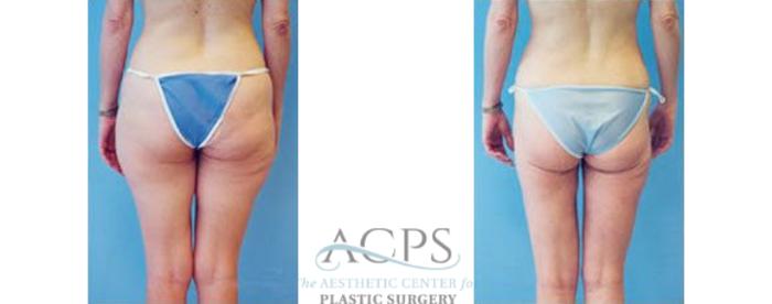Before & After Liposuction Case 399 Rear View: View in Houston, TX