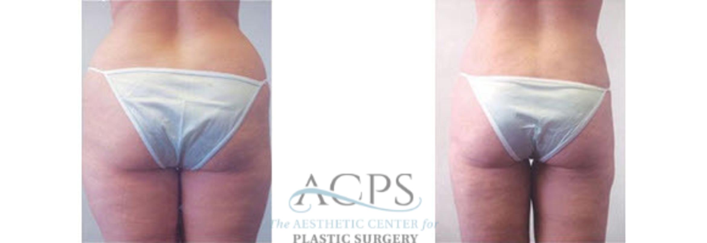 Before & After Liposuction Case 400 Rear View: View in Houston, TX