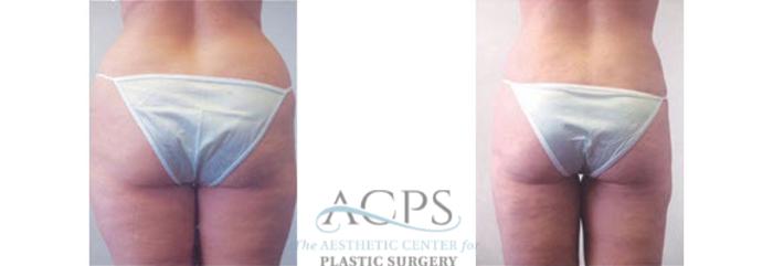 Before & After Liposuction Case 400 Rear View: View in Houston, TX