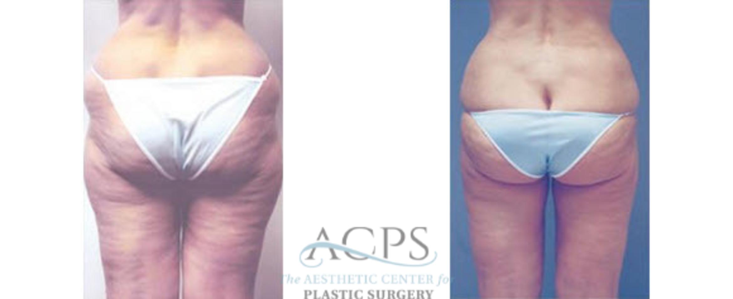 Before & After Liposuction Case 401 Rear View: View in Houston, TX