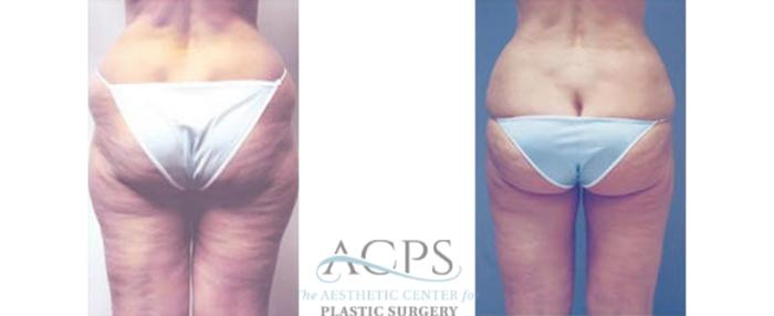Before & After Liposuction Case 401 Rear View: View in Houston, TX