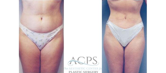 Before & After Liposuction Case 402 Front View: View in Houston, TX