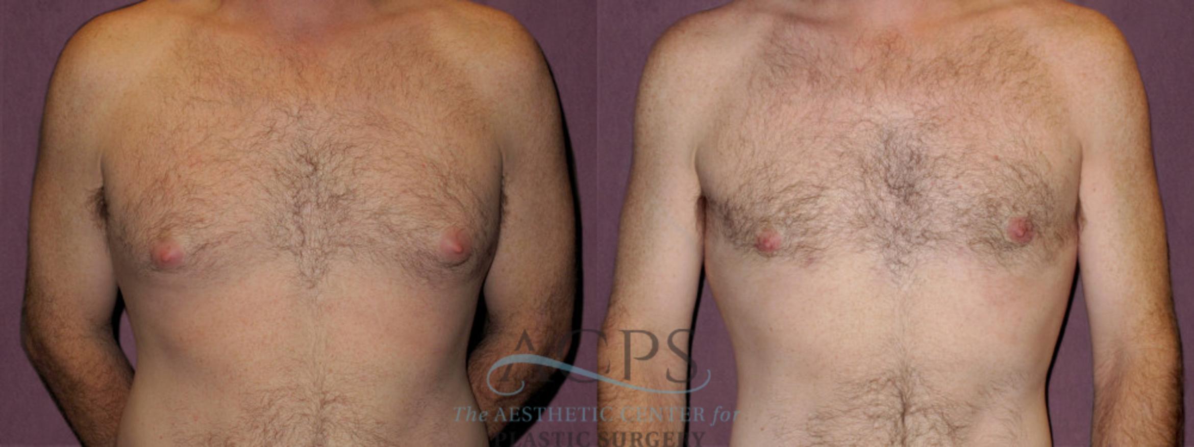 Before & After Male Body Contouring Case 1398 Front View: View in Houston, TX