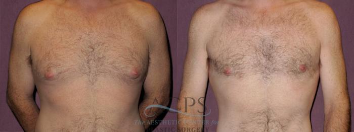 Before & After Male Body Contouring Case 1398 Front View: View in Houston, TX