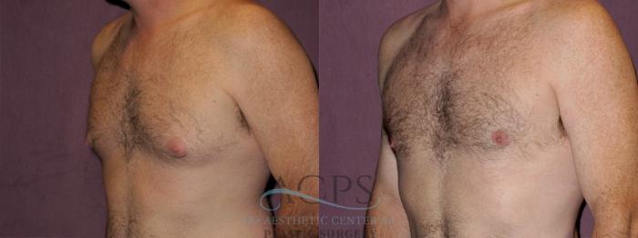 Before & After Male Body Contouring Case 1398 Oblique Left View: View in Houston, TX