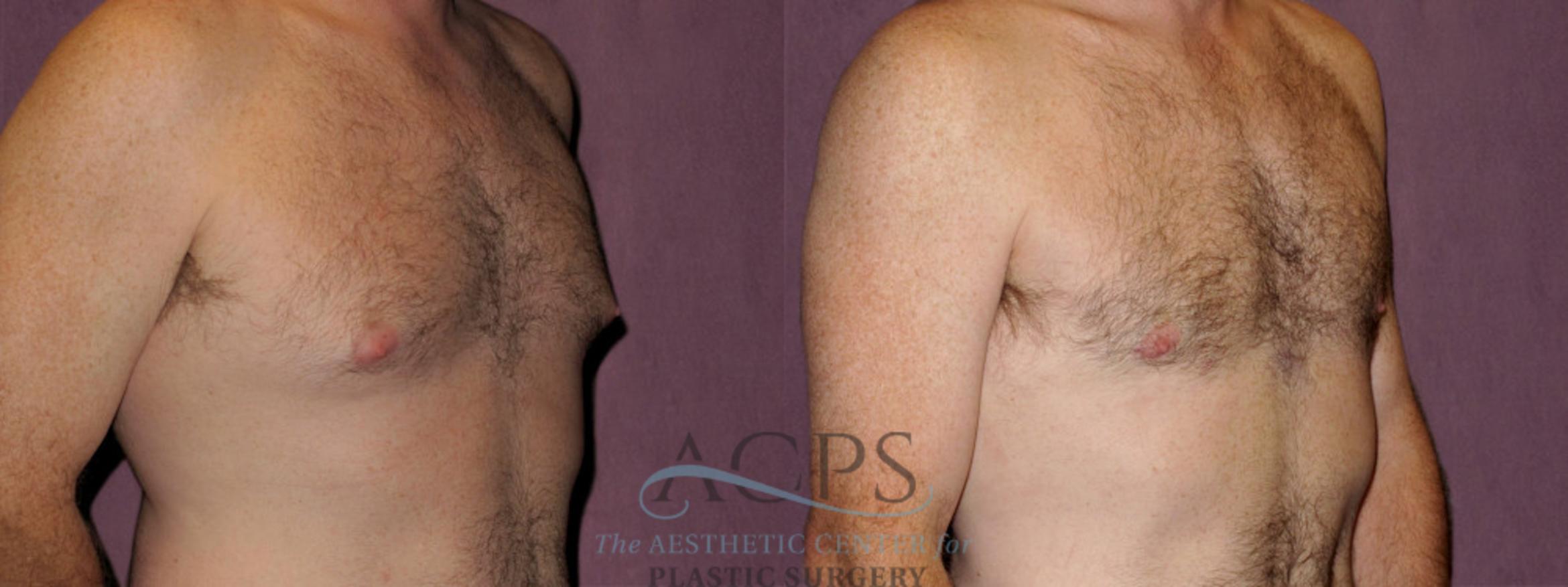 Before & After Male Body Contouring Case 1398 Oblique Right View: View in Houston, TX