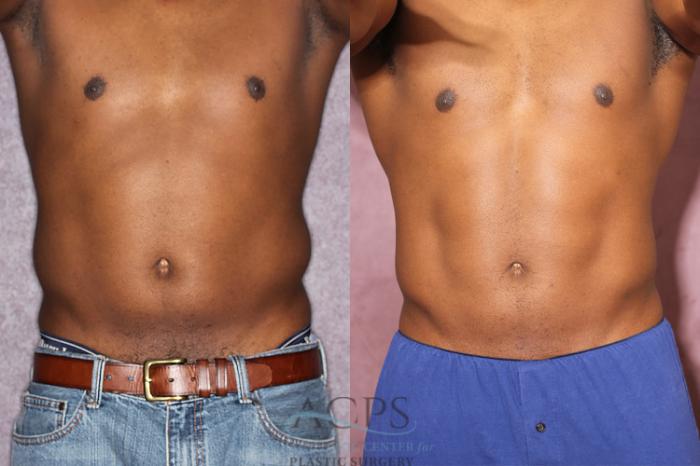 Before & After Male Body Contouring Case 1399 Front View: View in Houston, TX
