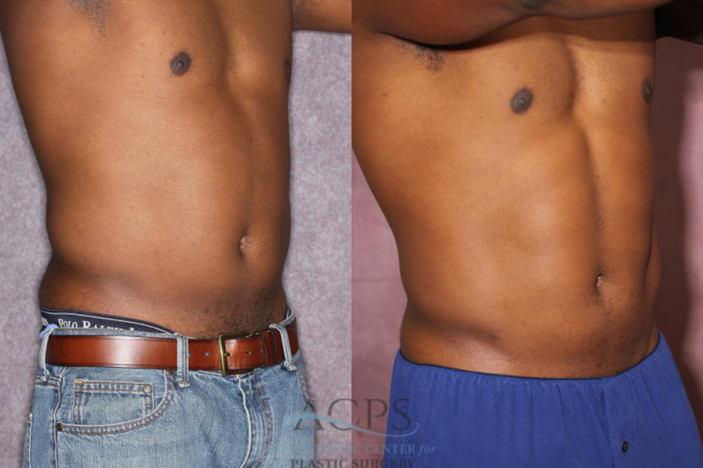 Before & After Male Body Contouring Case 1399 Oblique Right View: View in Houston, TX