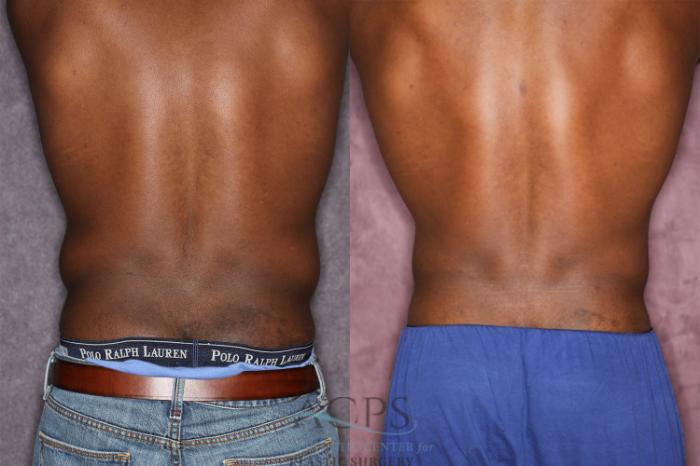 Before & After Male Body Contouring Case 1399 Rear View: View in Houston, TX