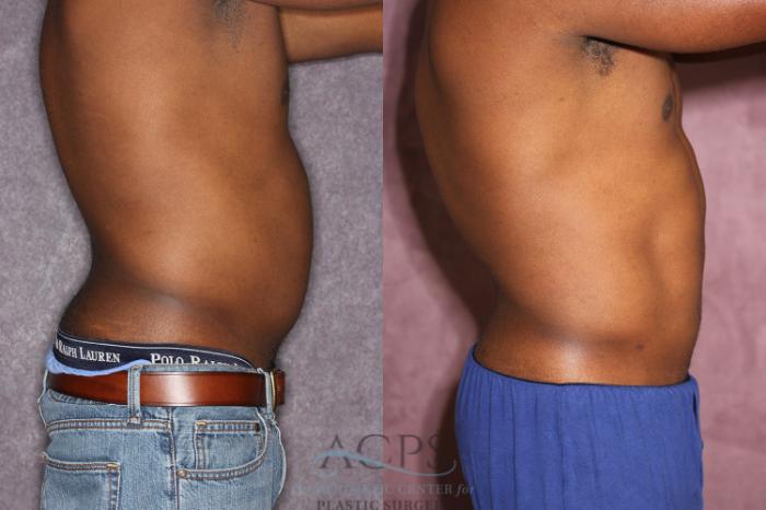 Before & After Male Body Contouring Case 1399 Side Right View: View in Houston, TX