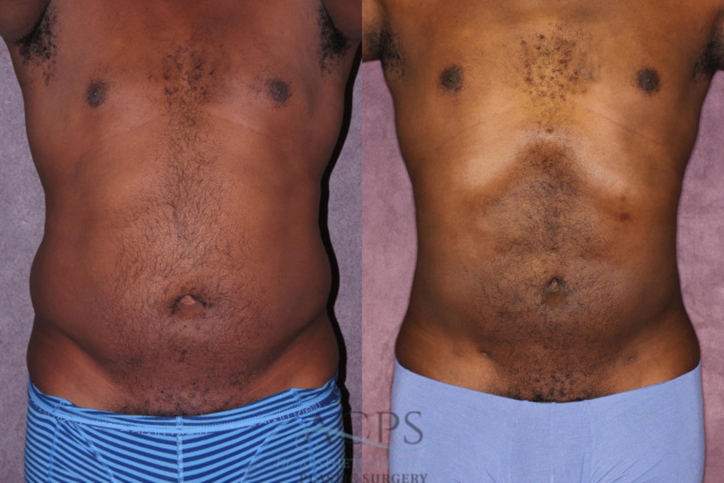 Before & After Male Body Contouring Case 1400 Front View: View in Houston, TX