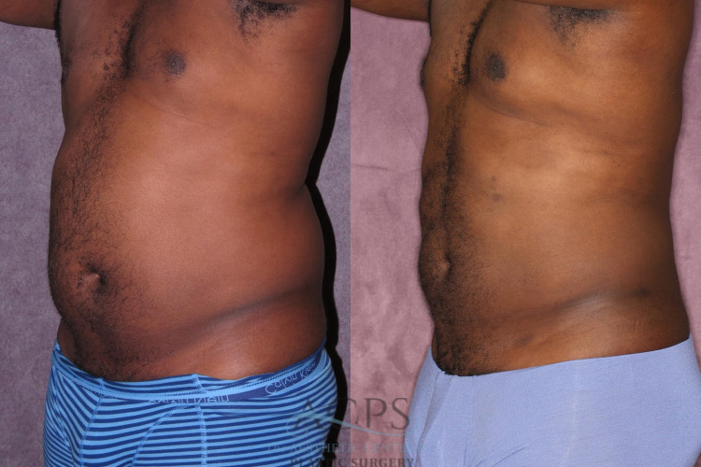 Before & After Male Body Contouring Case 1400 Oblique Left View: View in Houston, TX