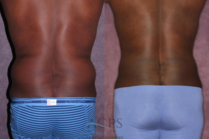 Before & After Male Body Contouring Case 1400 Rear View: View in Houston, TX