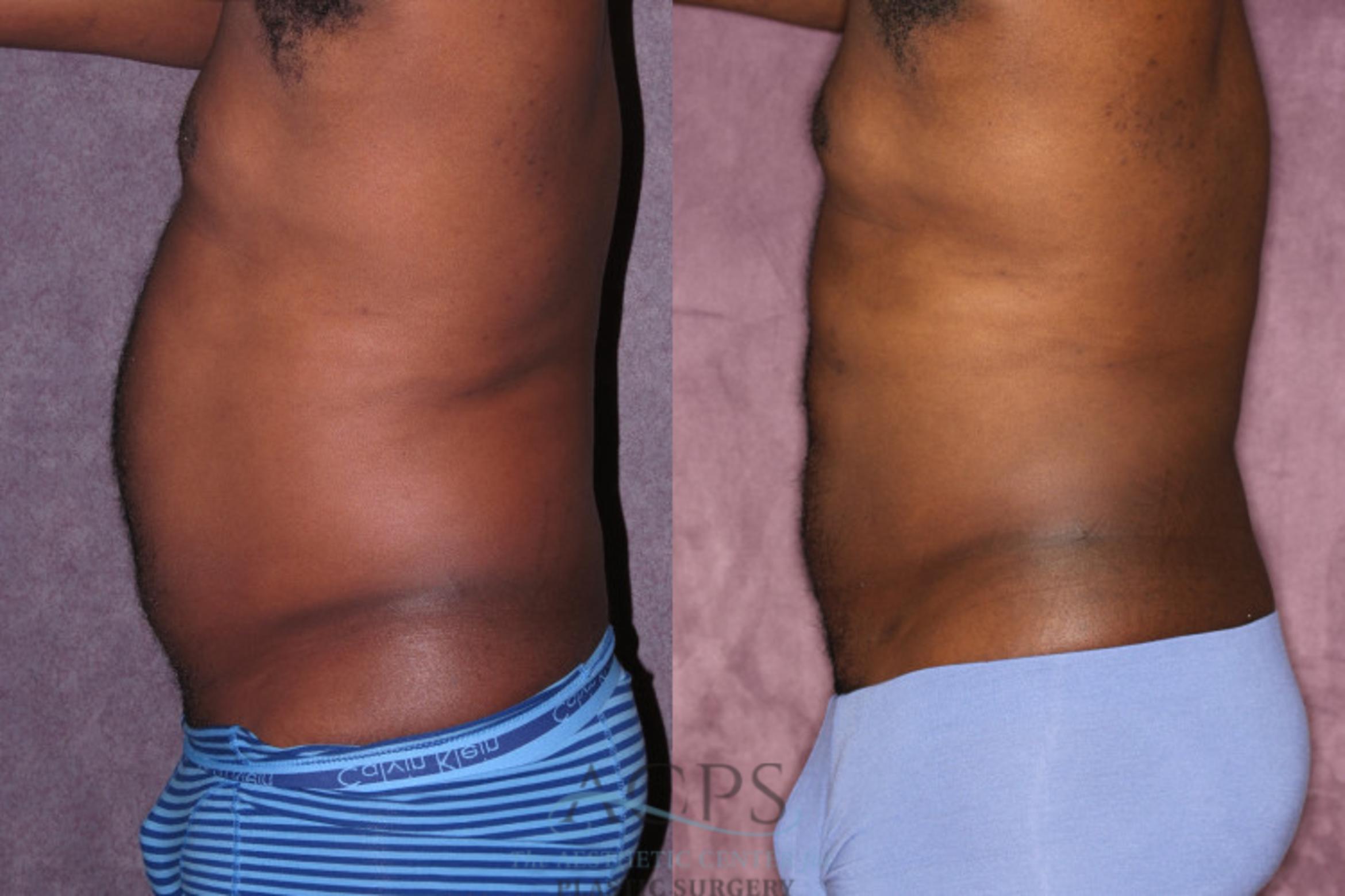 Before & After Male Body Contouring Case 1400 Side Left View: View in Houston, TX