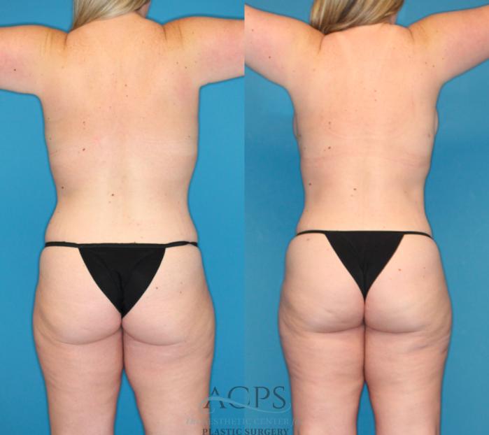 Before & After Tummy Tuck Case 1491 Back View in Houston, TX