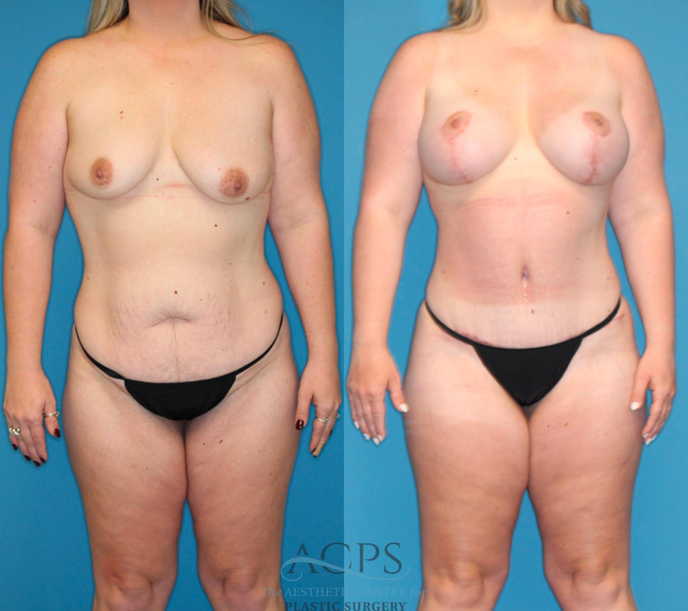 Before & After Tummy Tuck Case 1491 Front 2 View in Houston, TX