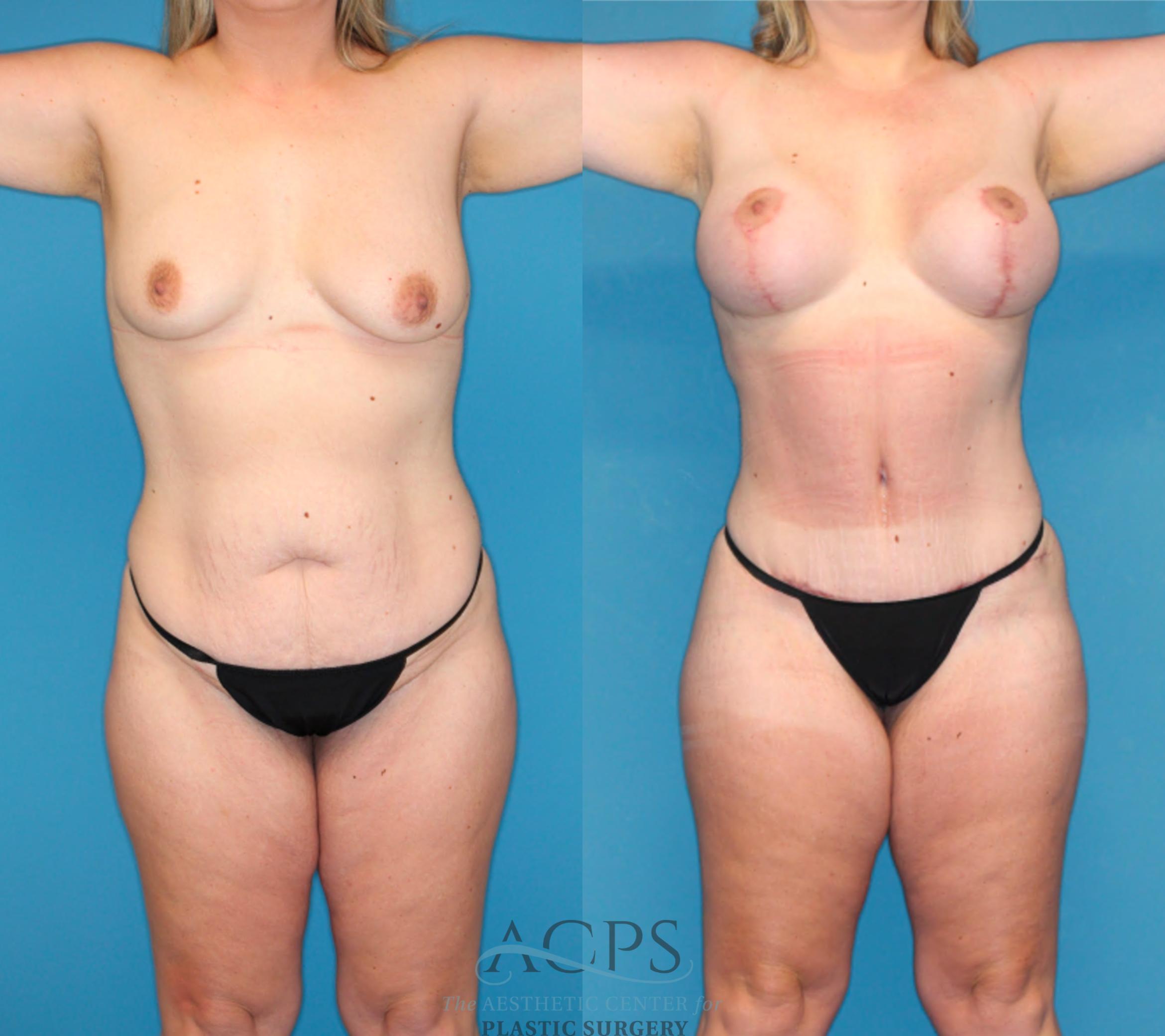 Before & After Mommy Makeover Case 1491 Front View in Houston, TX