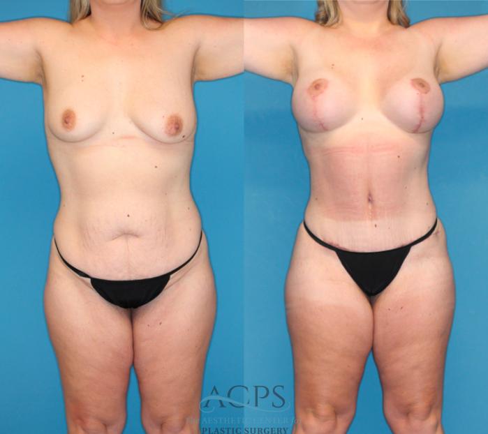 Before & After Mommy Makeover Case 1491 Front View in Houston, TX