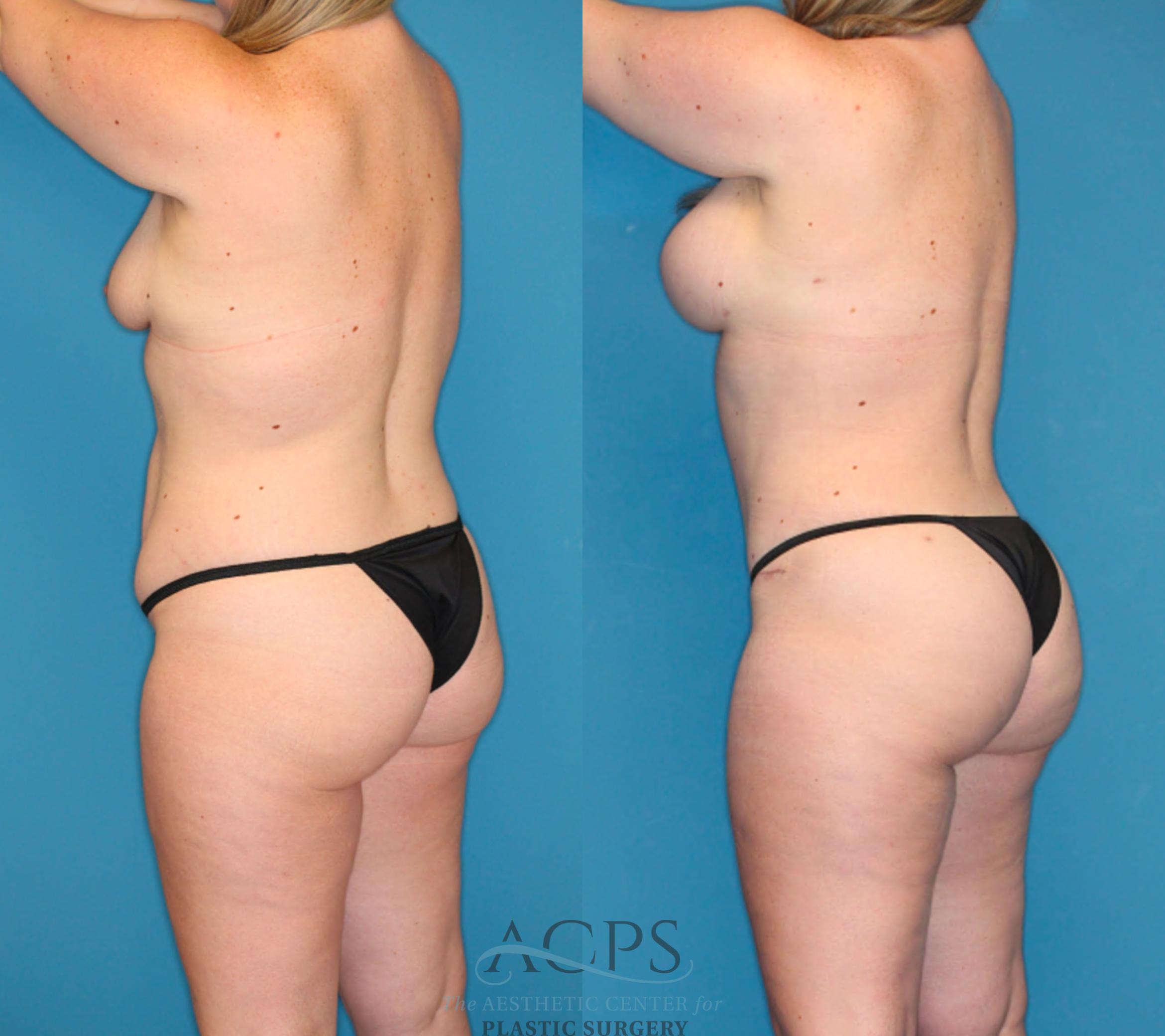 Before & After Tummy Tuck Case 1491 Left Rear View in Houston, TX
