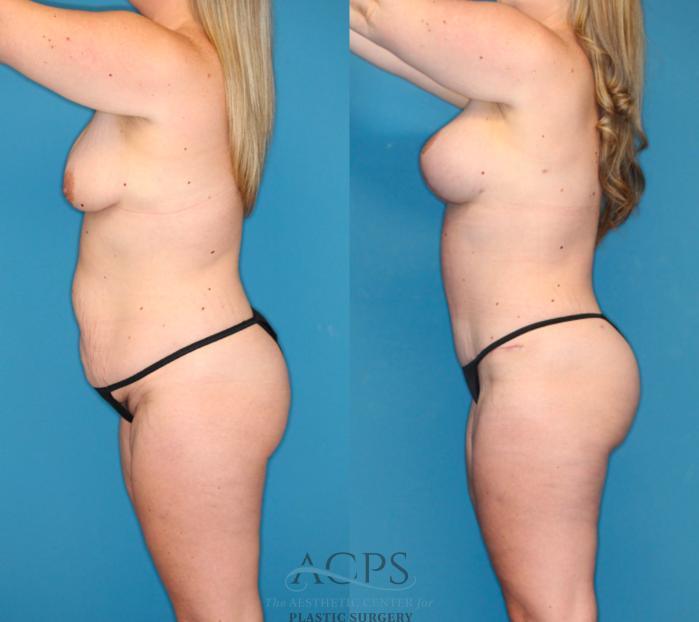 Before & After Tummy Tuck Case 1491 Left Side View in Houston, TX