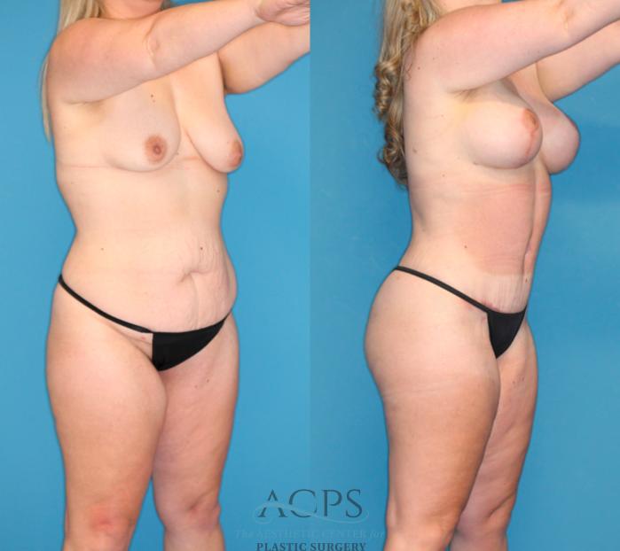 Before & After Tummy Tuck Case 1491 Right Oblique View in Houston, TX