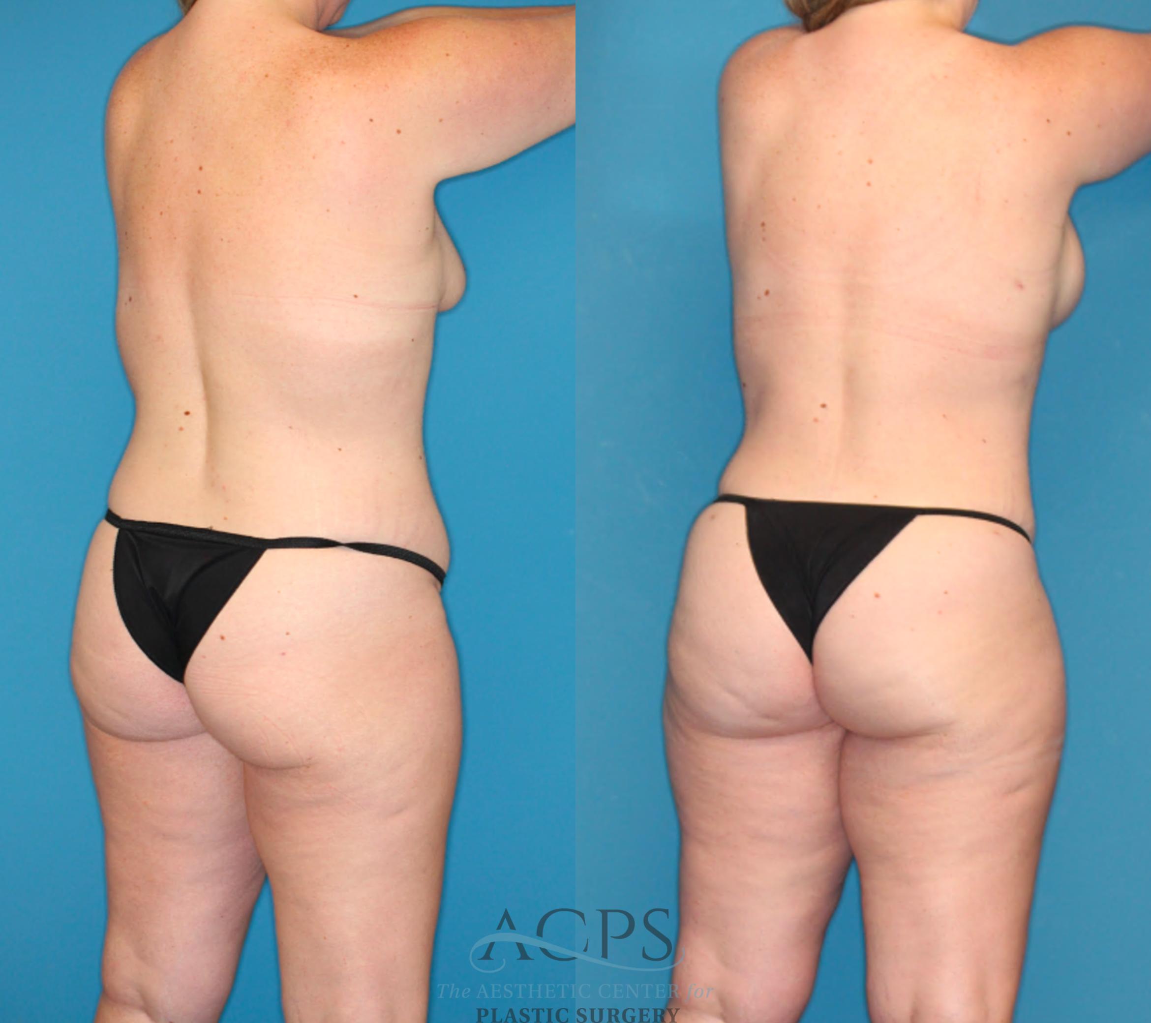 Before & After Tummy Tuck Case 1491 Right Rear View in Houston, TX