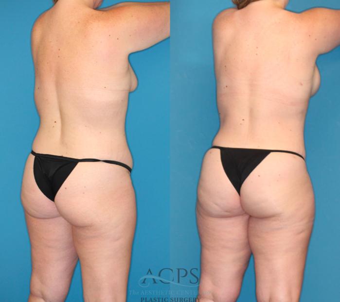 Before & After Tummy Tuck Case 1491 Right Rear View in Houston, TX