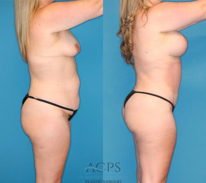 Before & After Tummy Tuck Case 1491 Right Side View in Houston, TX