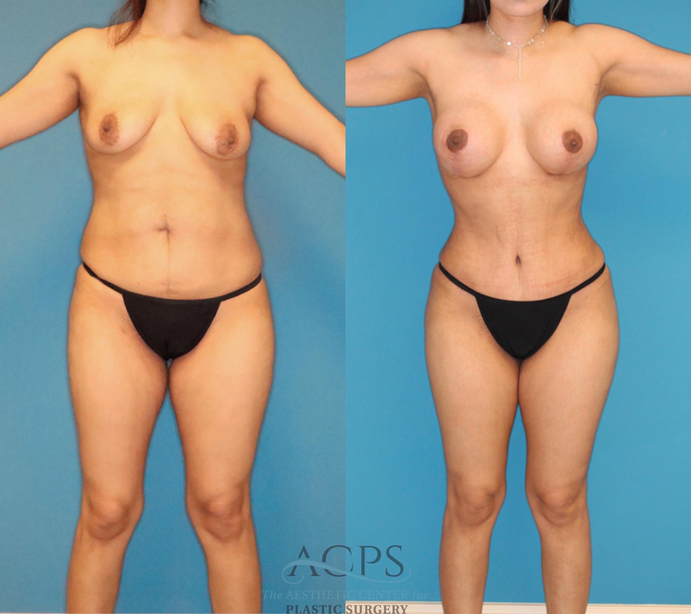 Before & After Mommy Makeover Case 1493 Front View in Houston, TX
