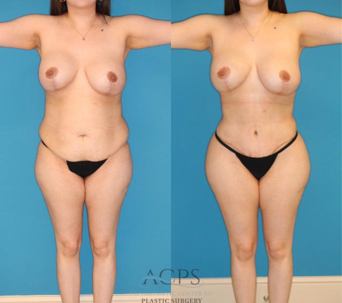 Before & After Brazilian Butt Lift (BBL) Case 1497 Front View in Houston, TX