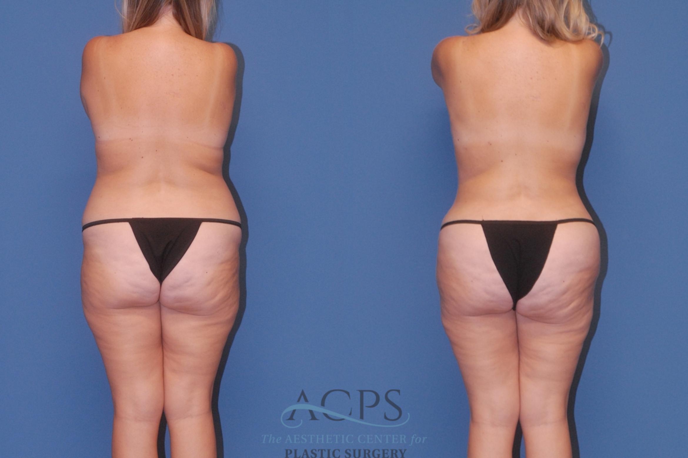 Before & After Breast Reduction Case 1514 Back View in Houston, TX