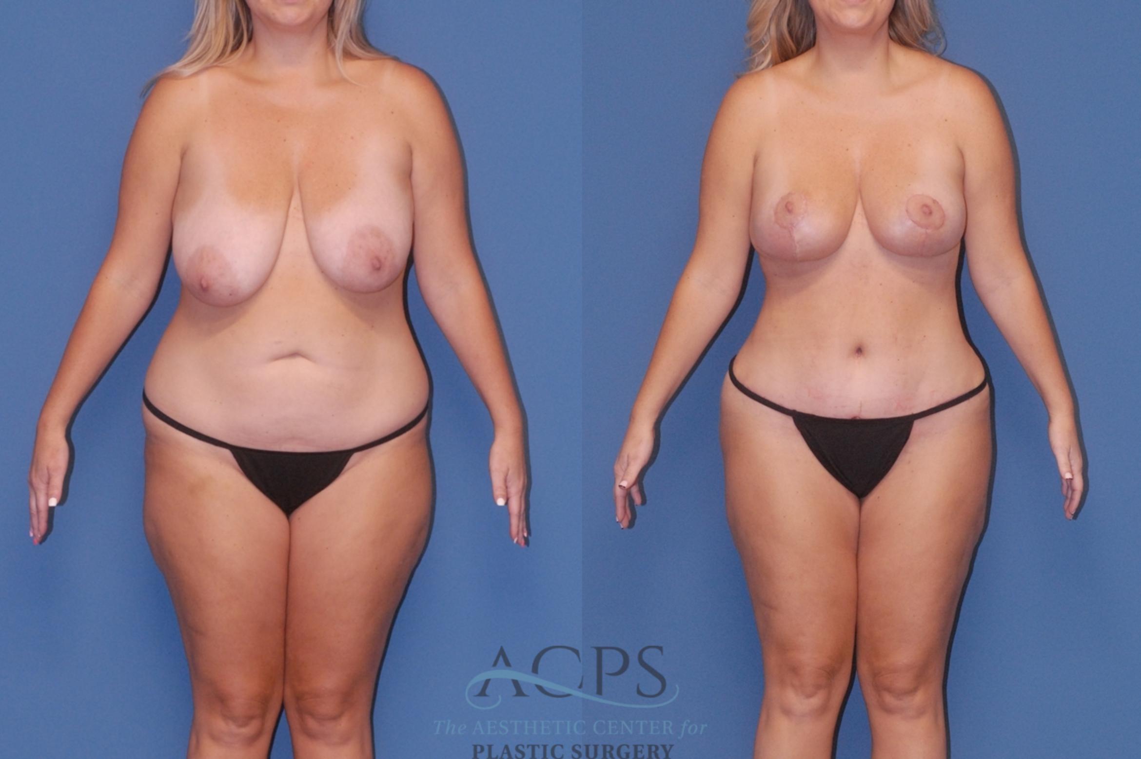 Before & After Breast Reduction Case 1514 Front View in Houston, TX