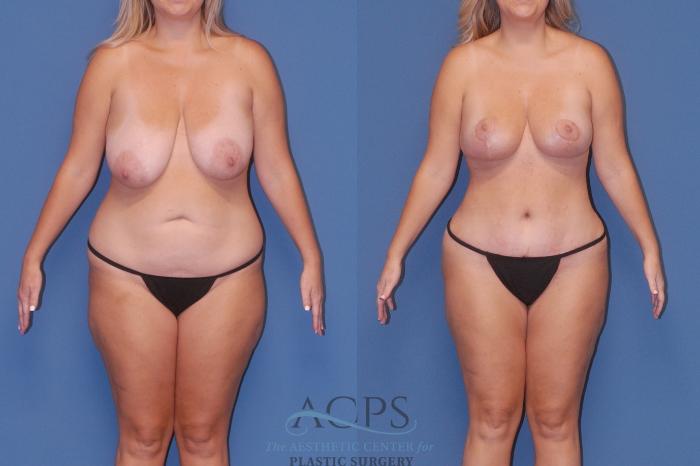 Before & After Breast Reduction Case 1514 Front View in Houston, TX