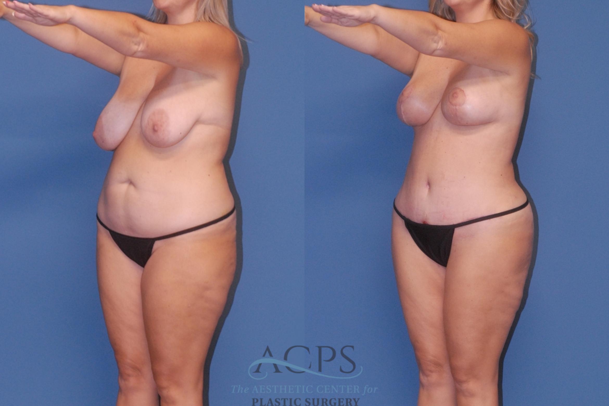 Before & After Breast Reduction Case 1514 Right Oblique View in Houston, TX