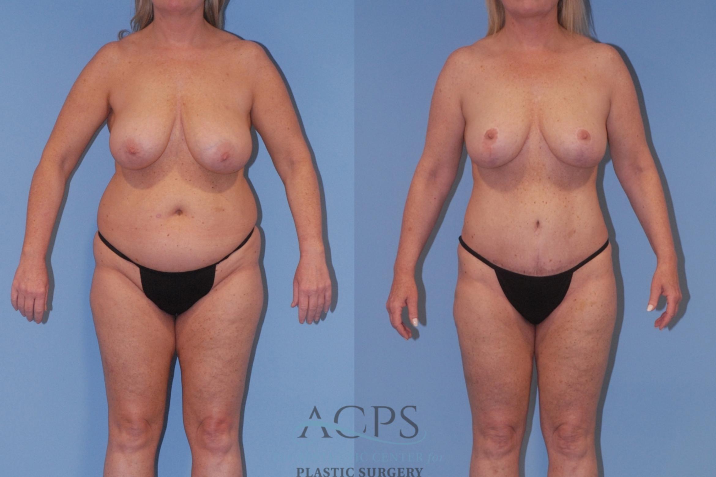 Before & After Breast Reduction Case 1515 Front View in Houston, TX