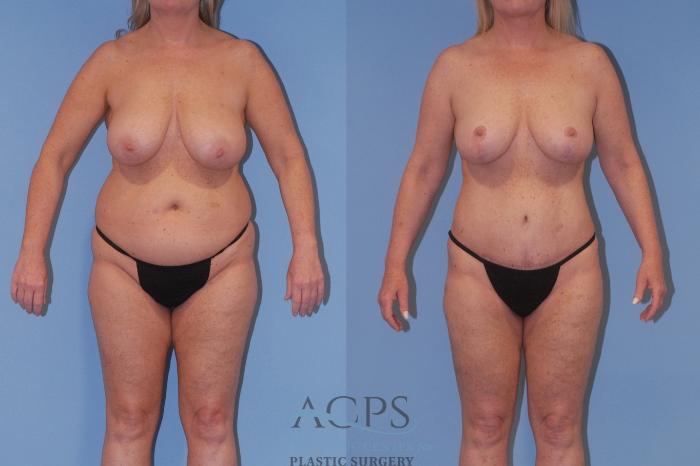 Before & After Breast Reduction Case 1515 Front View in Houston, TX