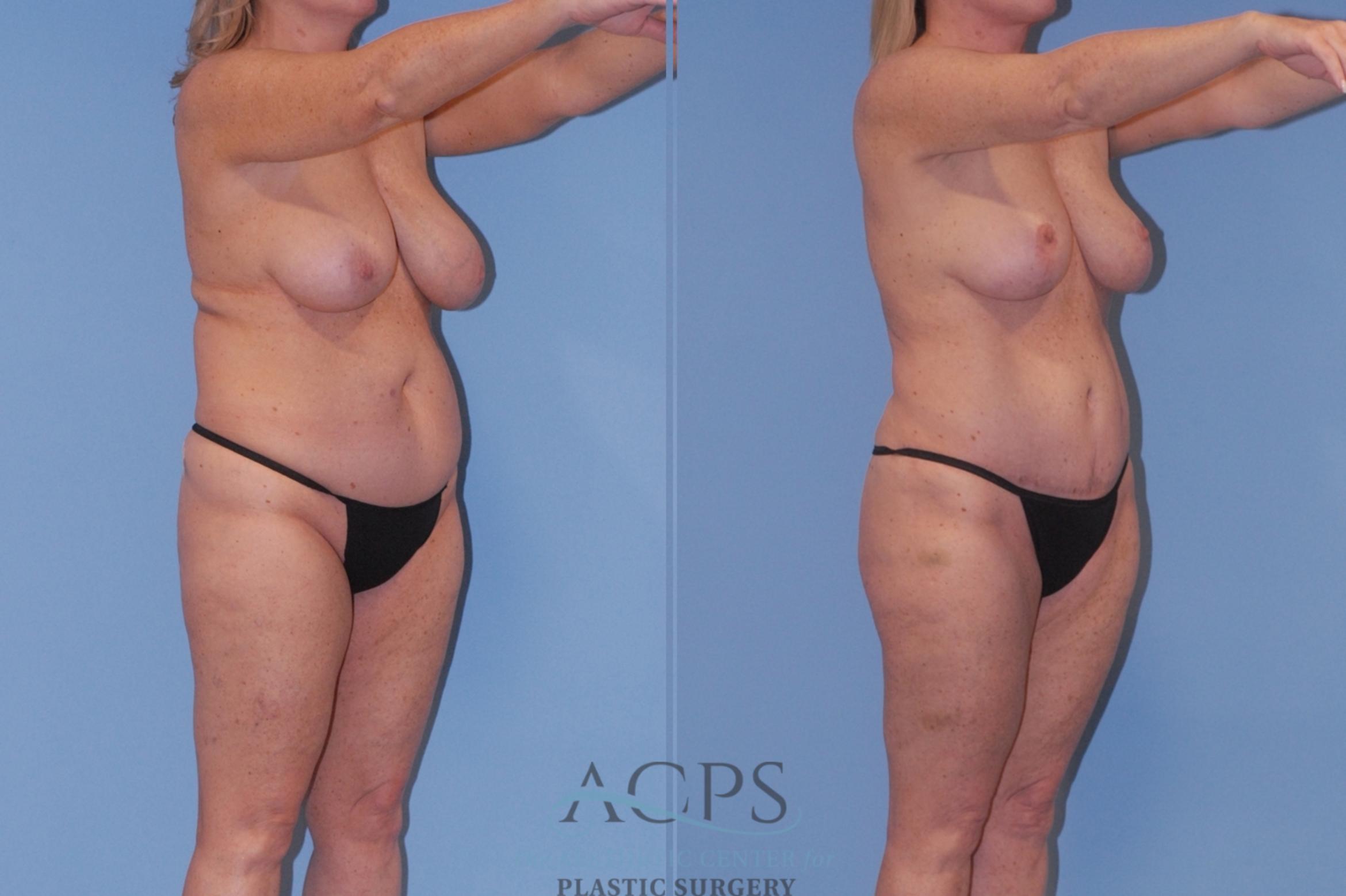 Before & After Breast Reduction Case 1515 Right Oblique View in Houston, TX