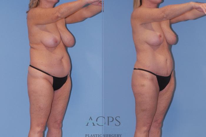 Before & After Breast Reduction Case 1515 Right Oblique View in Houston, TX