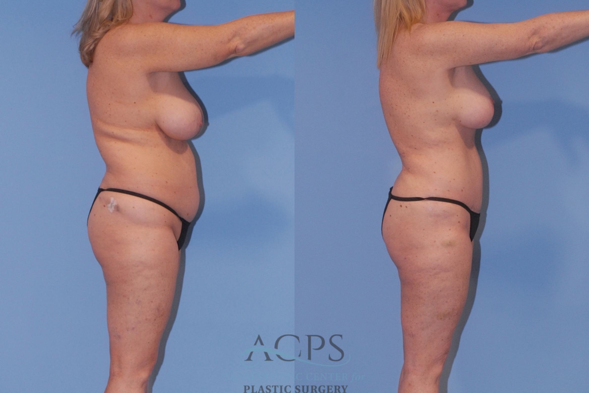 Before & After Breast Reduction Case 1515 Right Side View in Houston, TX