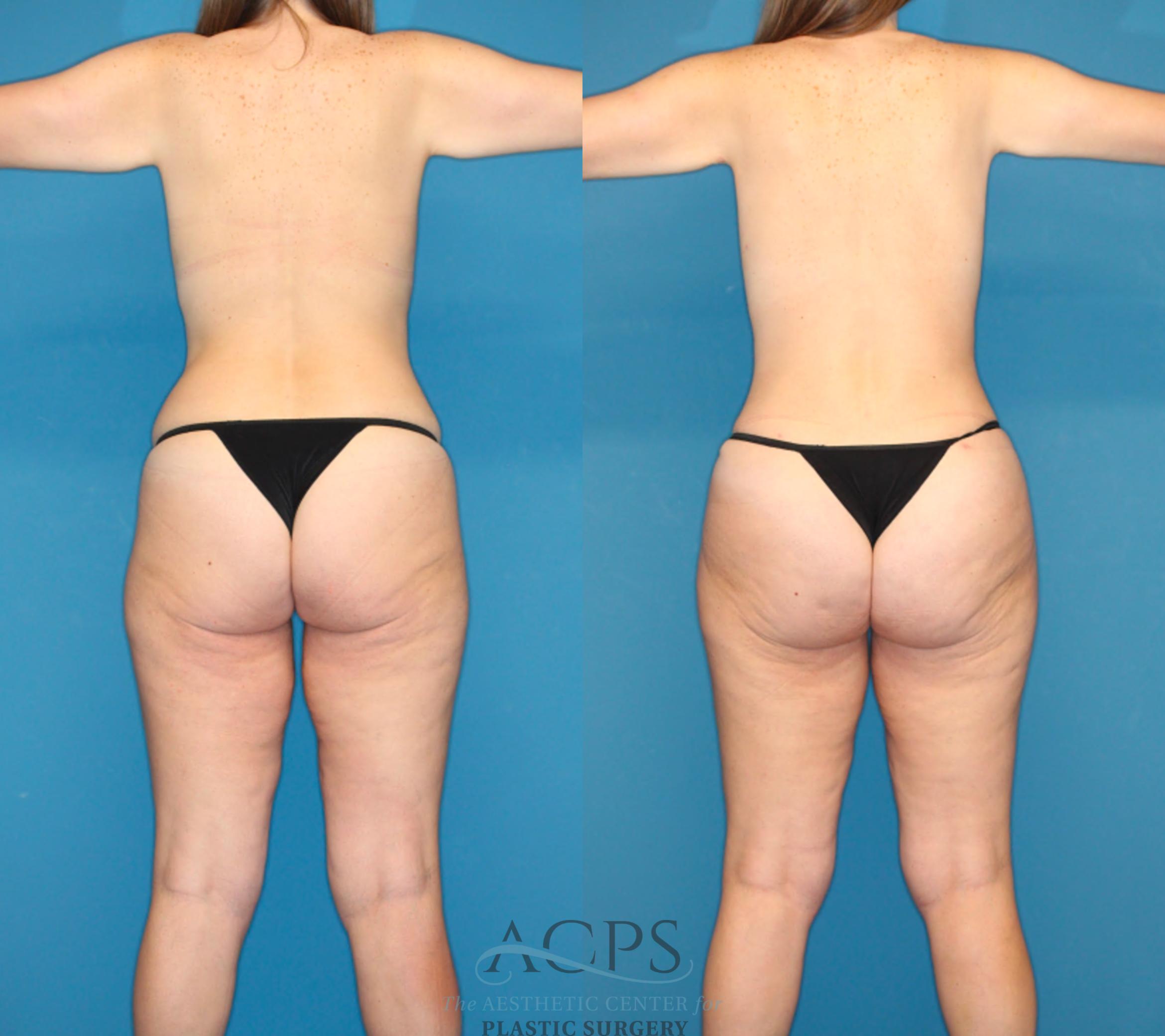 Before & After Mommy Makeover Case 1549 Back View in Houston, TX