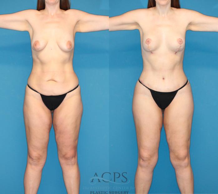 Before & After Mommy Makeover Case 1549 Front View in Houston, TX