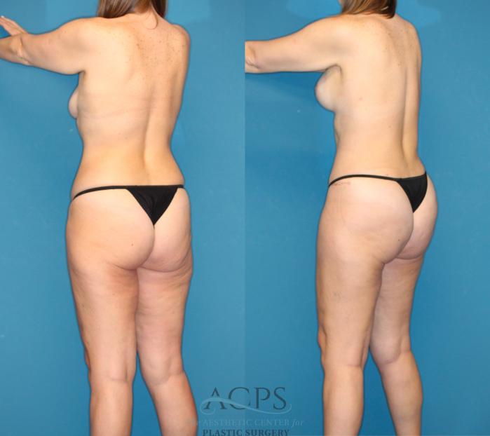 Before & After Mommy Makeover Case 1549 Left Rear View in Houston, TX